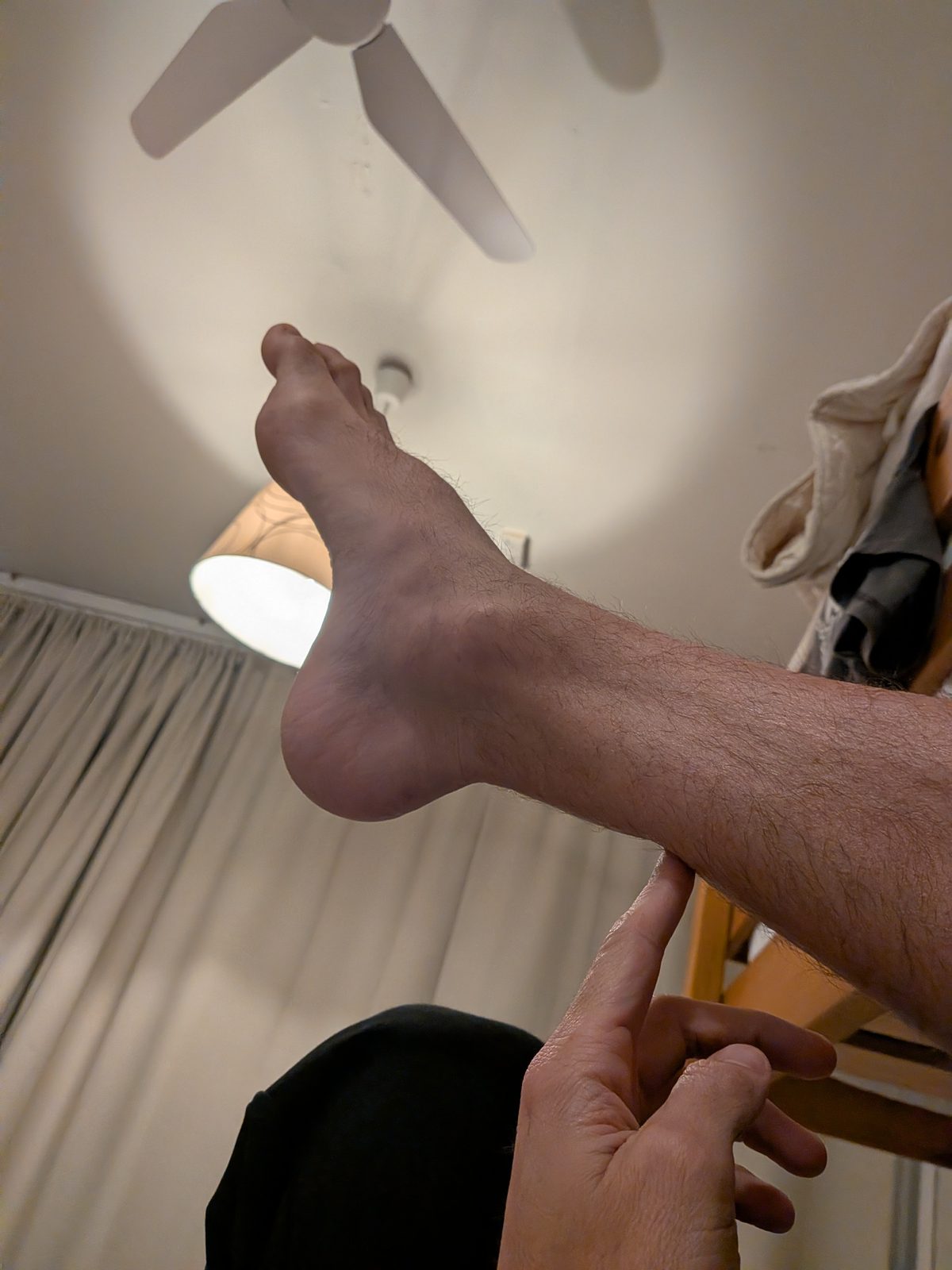 Foot hanging in natural plantarflexion immediately after Achilles tendon rupture — showing dropped foot position