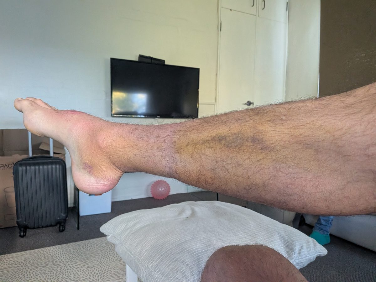 Significant swelling and bruising around ankle and heel 24-48 hours after Achilles tendon rupture