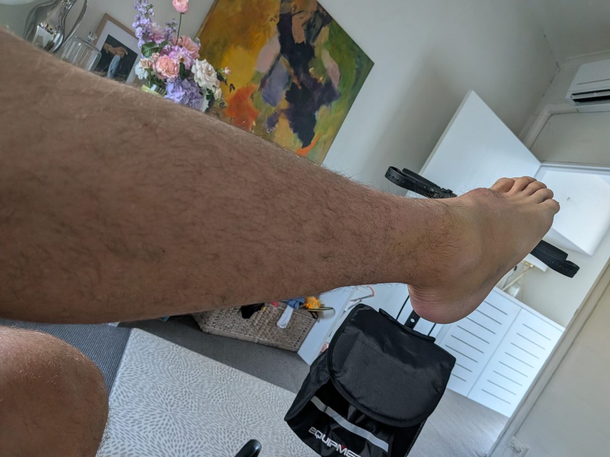 Knee scooter in use during early Achilles rupture recovery — showing swollen ankle visible above the scooter platform