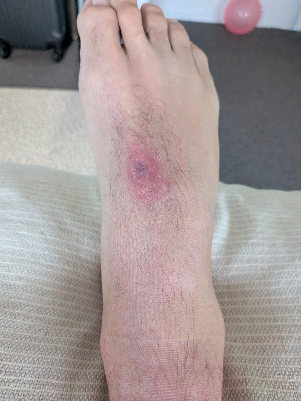 Pressure sore on top of foot caused by walking boot strap fitted too tightly in week one of Achilles rupture recovery